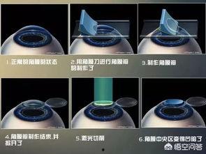 激光手术视频,精准微创，见证科技力量