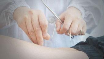 腰部针灸视频,视频详解与实操指南