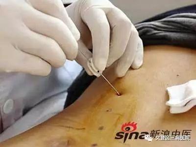 腰部针灸视频,视频详解与实操指南