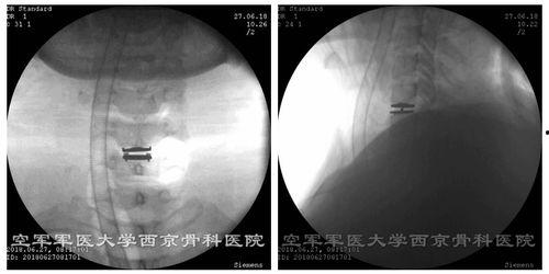 颈椎手术视频,从术前准备到术后康复