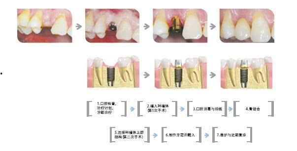 种牙视频全过程图片,从术前准备到术后恢复的全方位解析