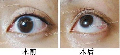 洗眼线视频,告别眼部困扰